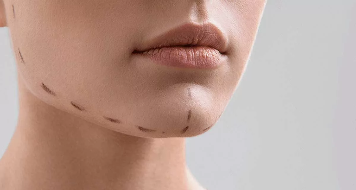 Nişantaşı Çene Dolgusu